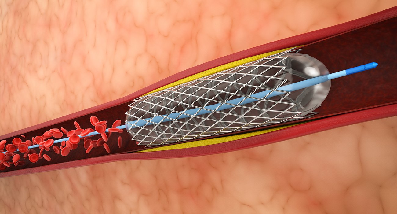 Medical illustration showing a peripheral stenting procedure, where a stent opens a blocked artery in the leg to restore blood flow.