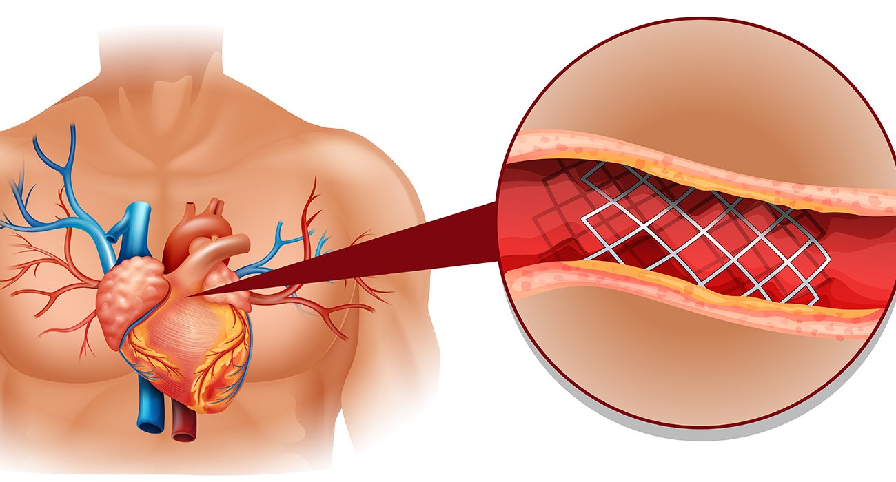 An expert cardiology team in Chennai performing an emergency primary angioplasty in a modern cath lab to treat a heart attack.