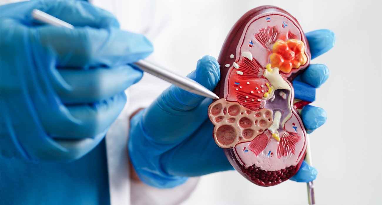 Medical illustration showing renal artery stenting, with a stent opening a blocked renal artery to restore blood flow to the kidney.